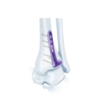 Los fragmentos grandes son implantes ortopédicos diseñados para tratar fracturas de huesos largos como el fémur, tibia y húmero.
Incluyen placas y tornillos de mayor tamaño y resistencia, capaces de soportar el peso corporal y estabilizar fracturas más complejas.