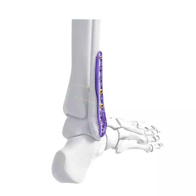 Placas robustas para fracturas mayores. Brindan alta resistencia, estabilidad superior y soporte confiable en procedimientos ortopédicos de mayor complejidad.