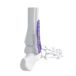 Placas ortopédicas de uso médico para fijación y estabilización de huesos en cirugías traumatológicas