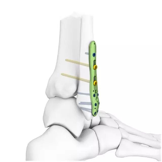 Placas robustas para fracturas mayores. Brindan alta resistencia, estabilidad superior y soporte confiable en procedimientos ortopédicos de mayor complejidad.
