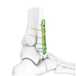 Placas ortopédicas de acero quirúrgico utilizadas en procedimientos de osteosíntesis
