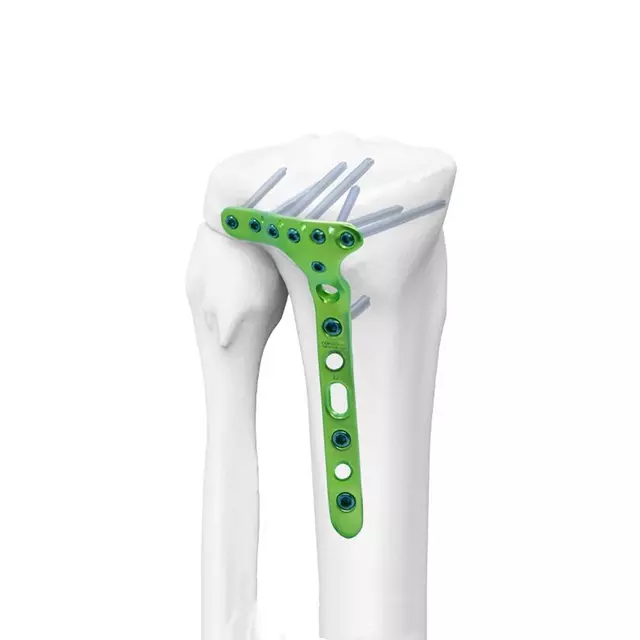 Placas robustas para fracturas mayores. Brindan alta resistencia, estabilidad superior y soporte confiable en procedimientos ortopédicos de mayor complejidad.
