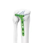 Los fragmentos grandes son implantes ortopédicos diseñados para tratar fracturas de huesos largos como el fémur, tibia y húmero.
Incluyen placas y tornillos de mayor tamaño y resistencia, capaces de soportar el peso corporal y estabilizar fracturas más complejas.